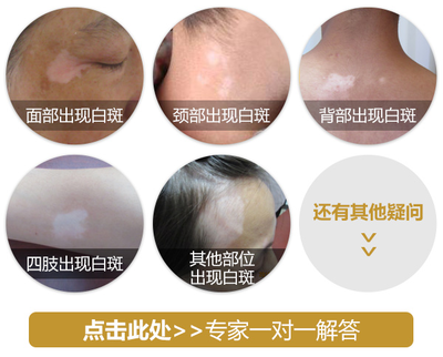 合肥白癜风医院讲解脸部白癜风如何引起?